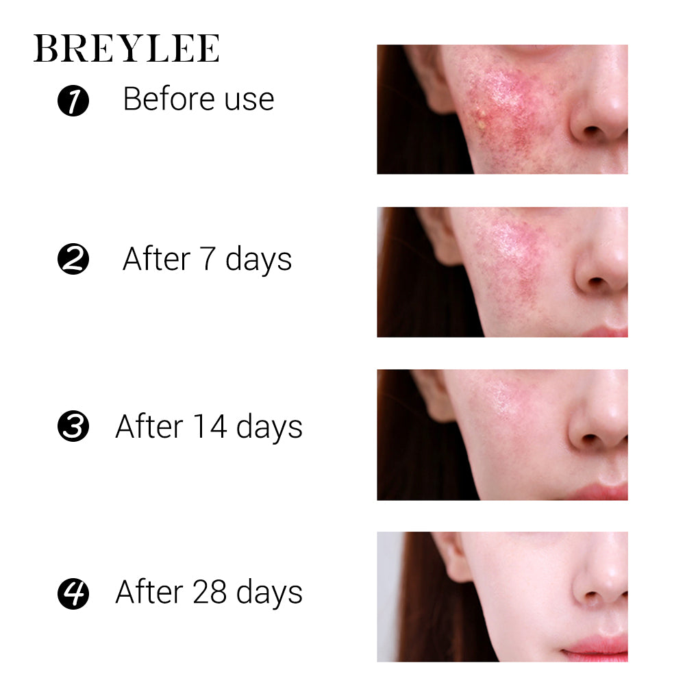 Breylee's Acne Pimple Skin Repair